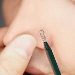 [PyunkangYul] Pimple Extractor 3